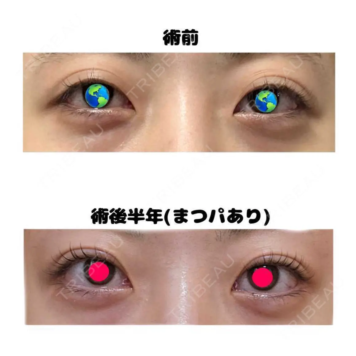 二重埋没 / 目頭切開 / 目尻切開 / タレ目形成・グラマラスライン（切開） / 眼瞼下垂（非切開） LUHO（ルホ）美容外科 AFTER