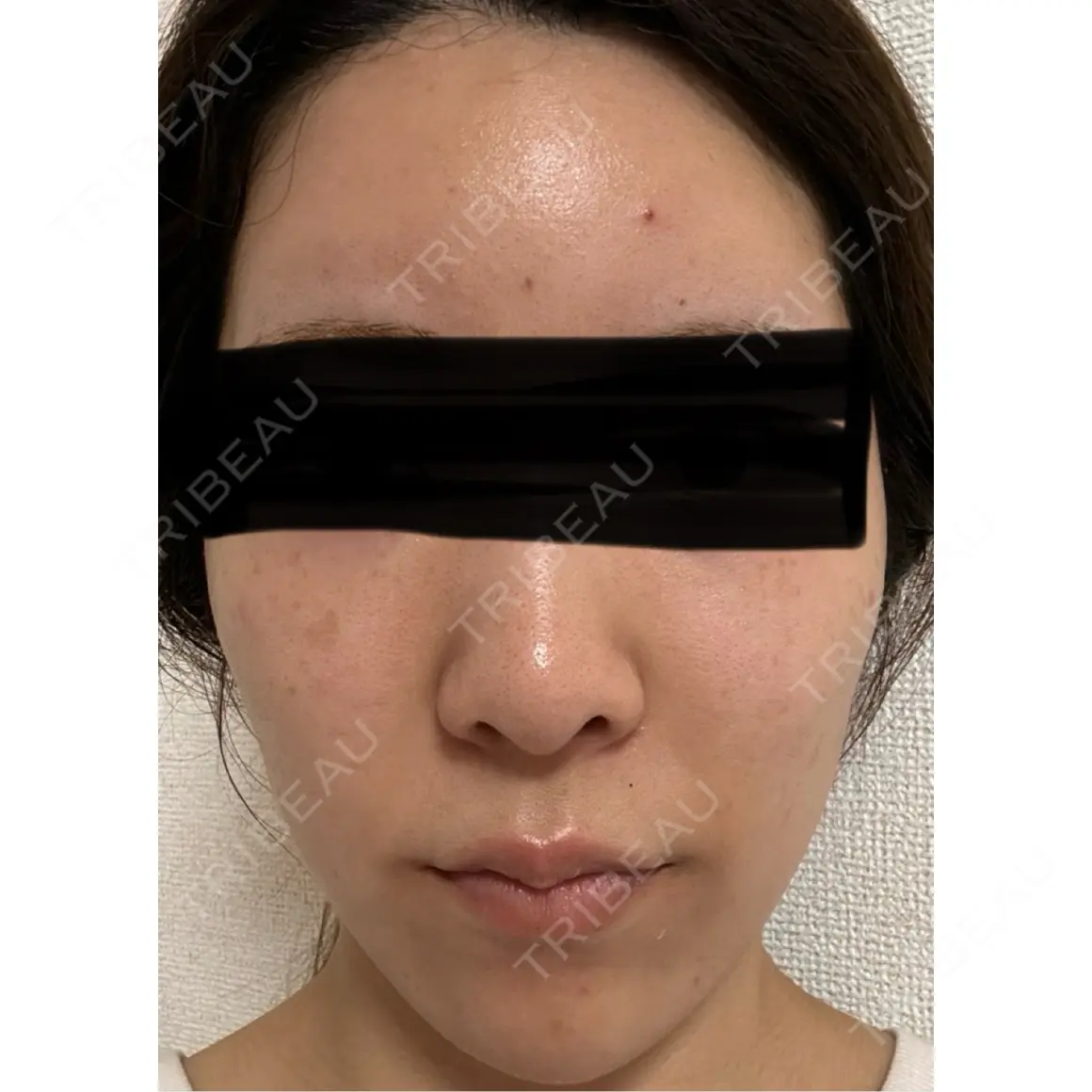 ヒアルロン酸注入（あご） / ヒアルロン酸注入（額） MIO CLINIC 梅田院 AFTER