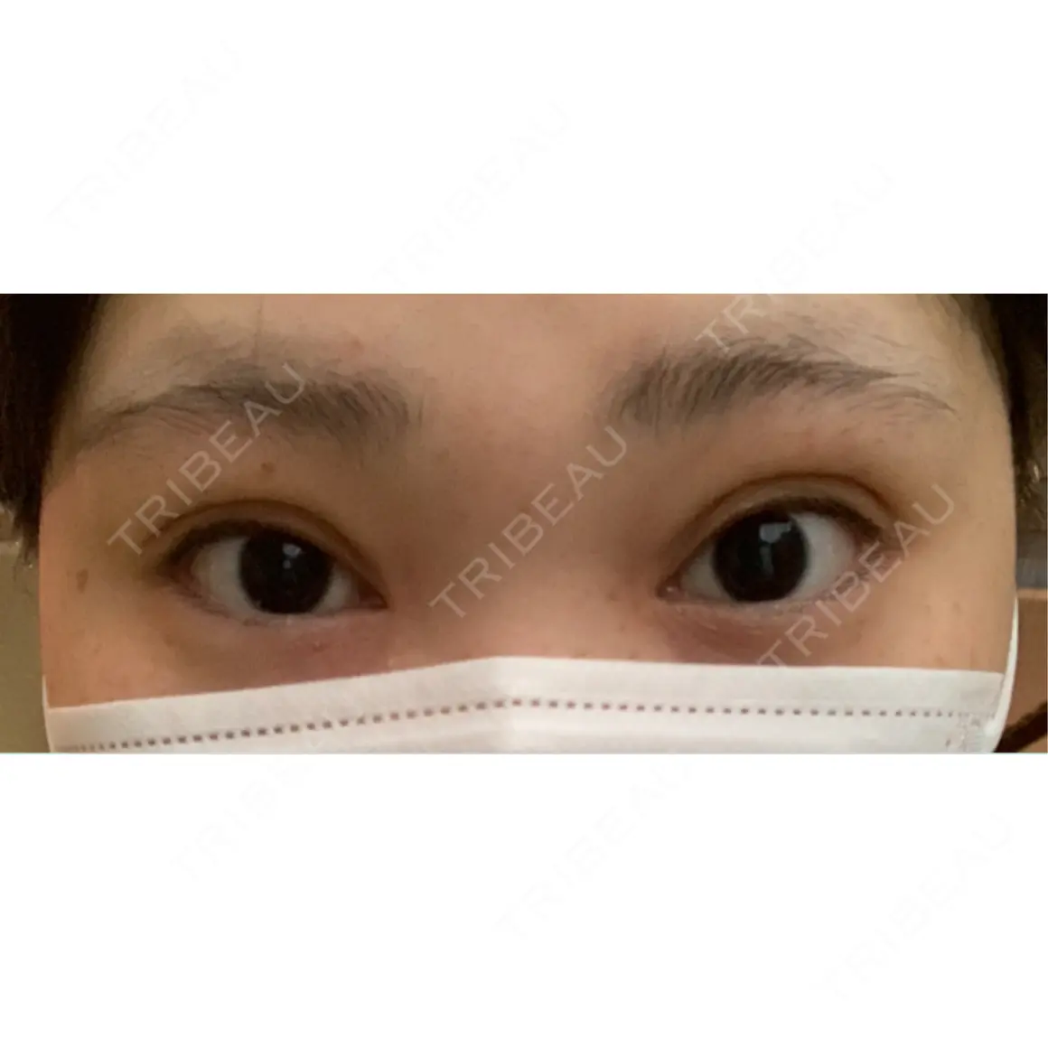 二重埋没 / 上まぶたの脂肪取り HAAB×DREAM BEAUTY CLINIC 東京本院 AFTER