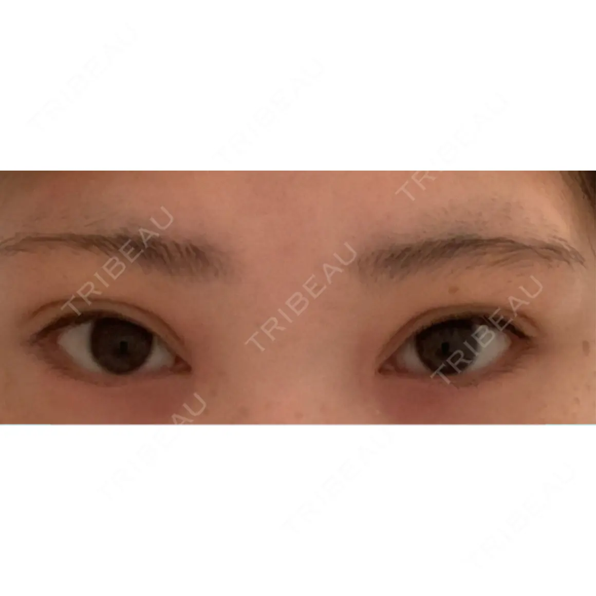 二重埋没 / 上まぶたの脂肪取り HAAB×DREAM BEAUTY CLINIC 東京本院 AFTER