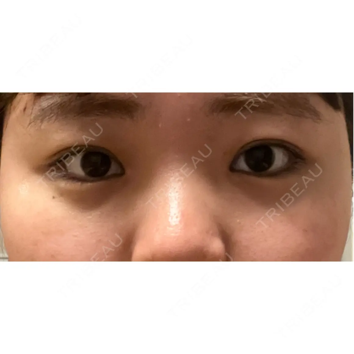 ヒアルロン酸注入（涙袋） MIO CLINIC 梅田院 DAY 2