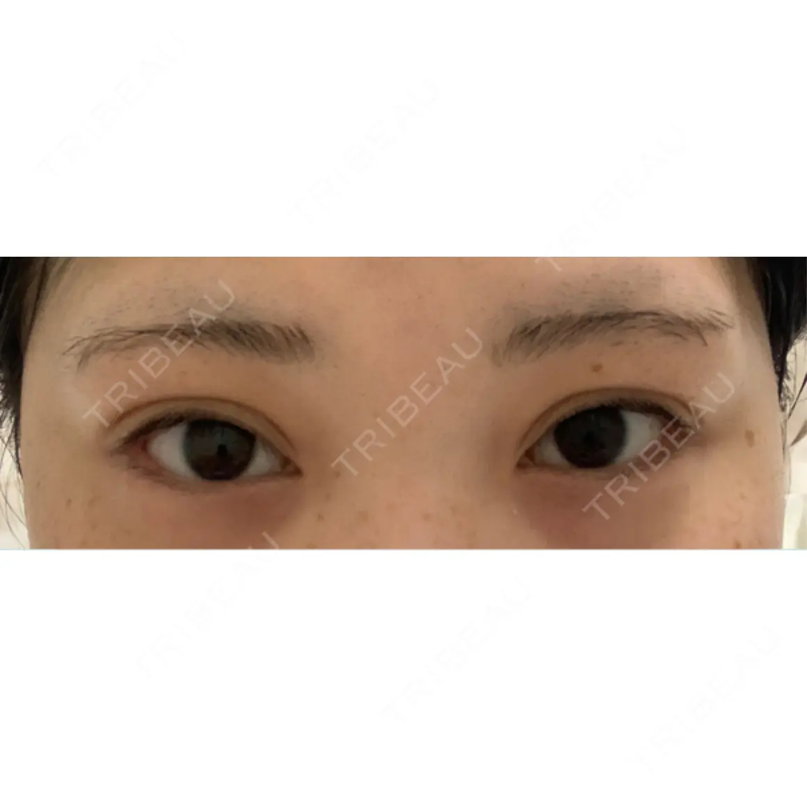二重埋没 / 上まぶたの脂肪取り HAAB×DREAM BEAUTY CLINIC 東京本院 AFTER