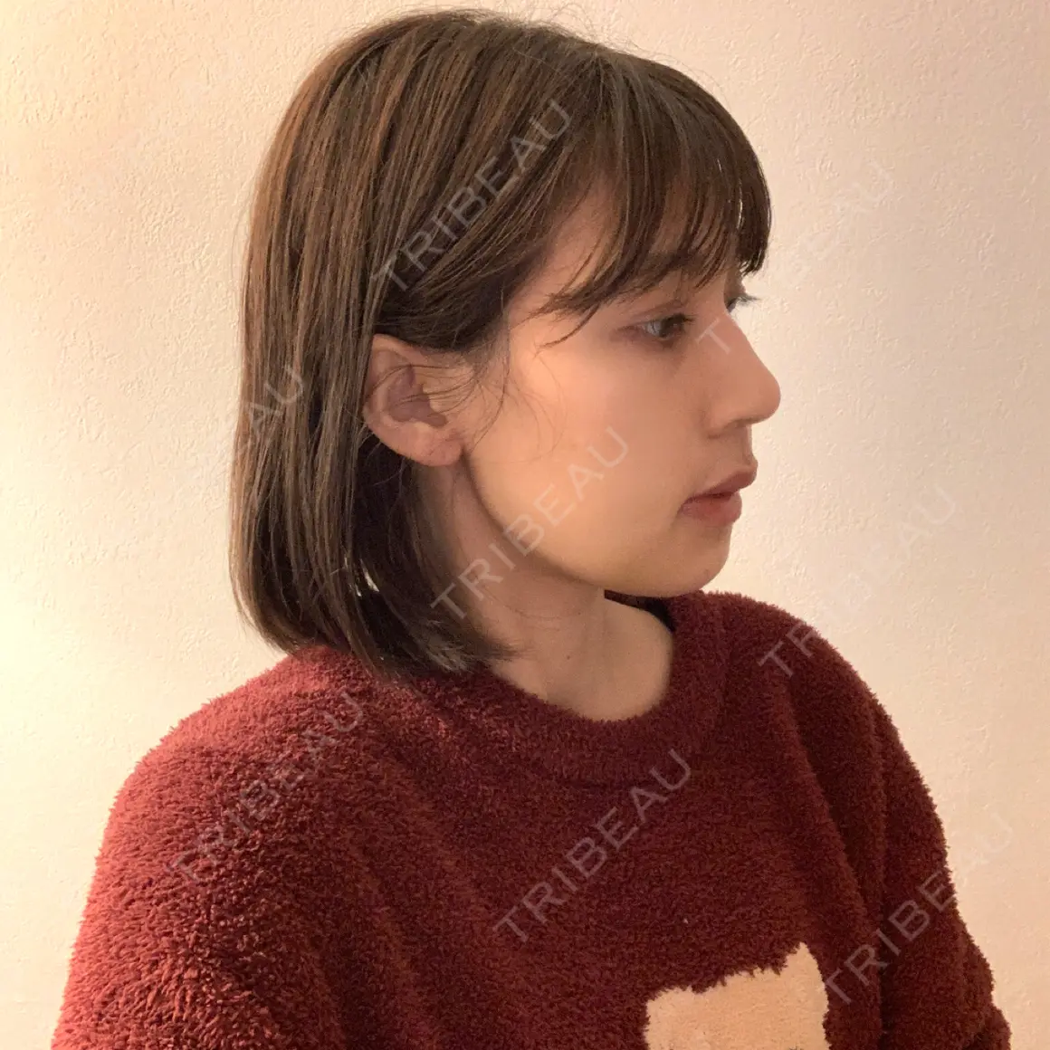 セットバック 大塚美容形成外科・歯科 大塚本院 DAY 26