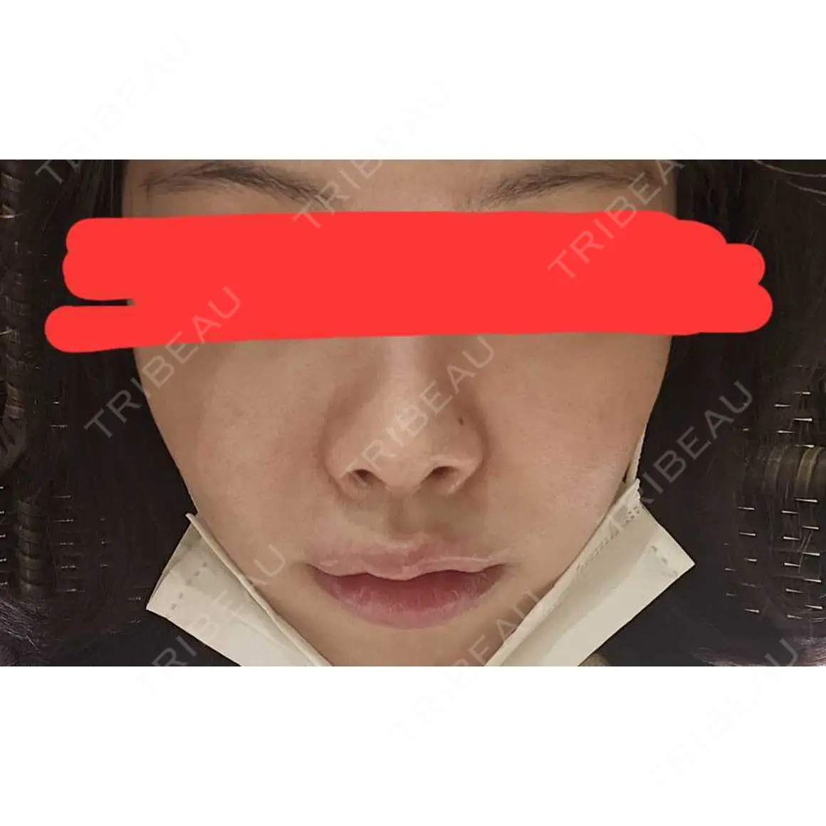 ボトックス（首） / ヒアルロン酸注入（鼻翼基部） KAGA CLINIC AFTER