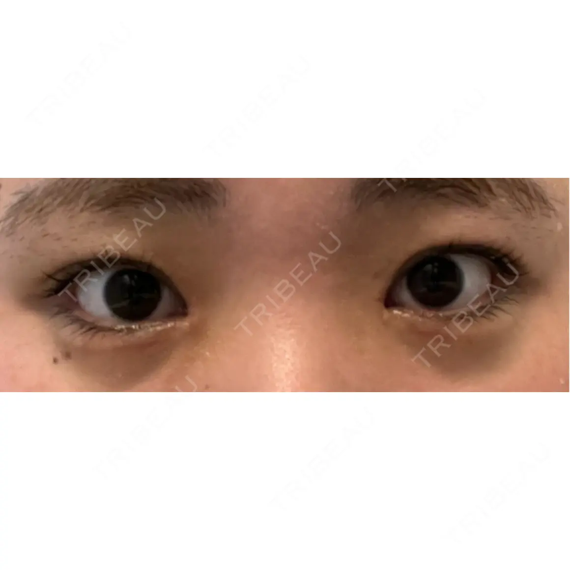 ヒアルロン酸注入（涙袋） MIO CLINIC 梅田院 AFTER