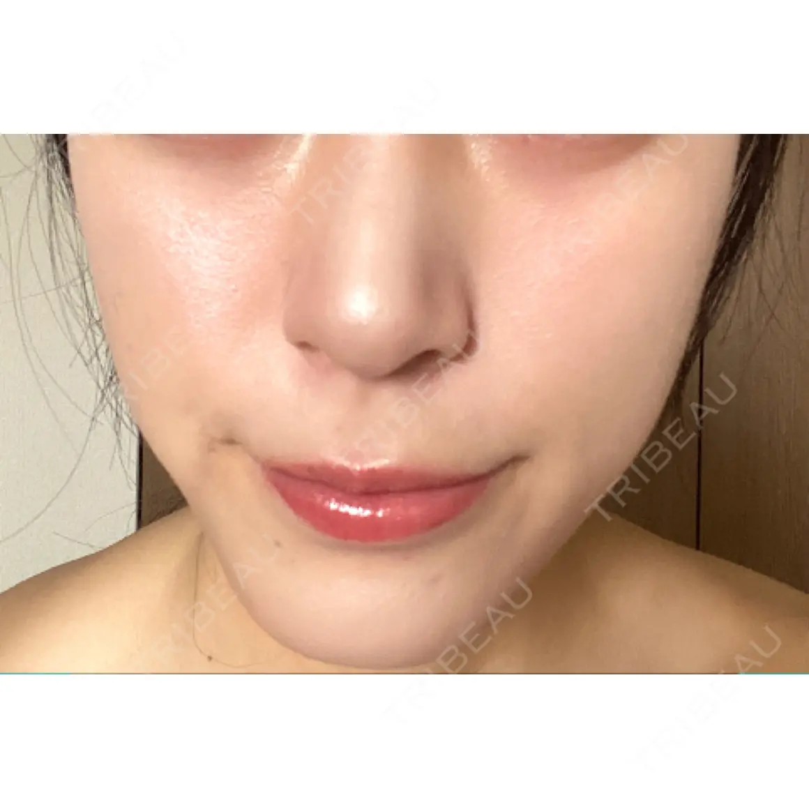 その他（肌） 美容皮膚科 デュークリニック AFTER