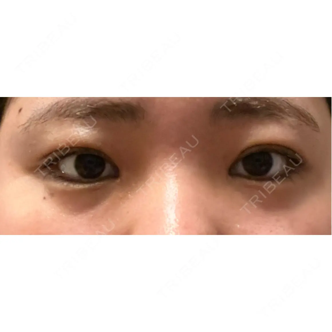 ヒアルロン酸注入（涙袋） MIO CLINIC 梅田院 AFTER
