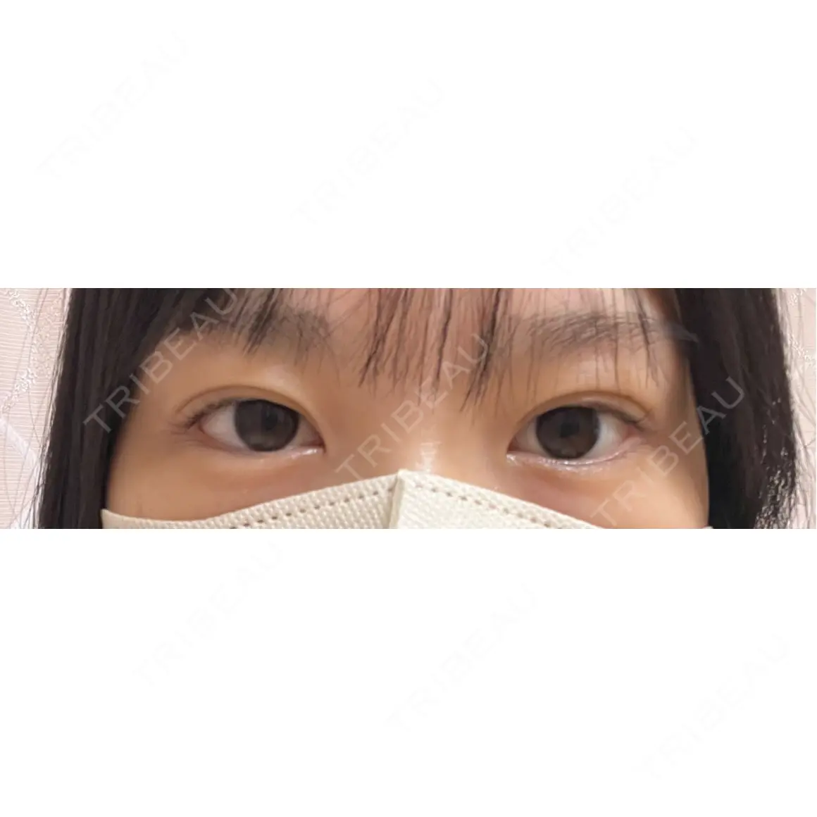 二重埋没 / 上まぶたの脂肪取り HAAB×DREAM BEAUTY CLINIC 東京本院 AFTER