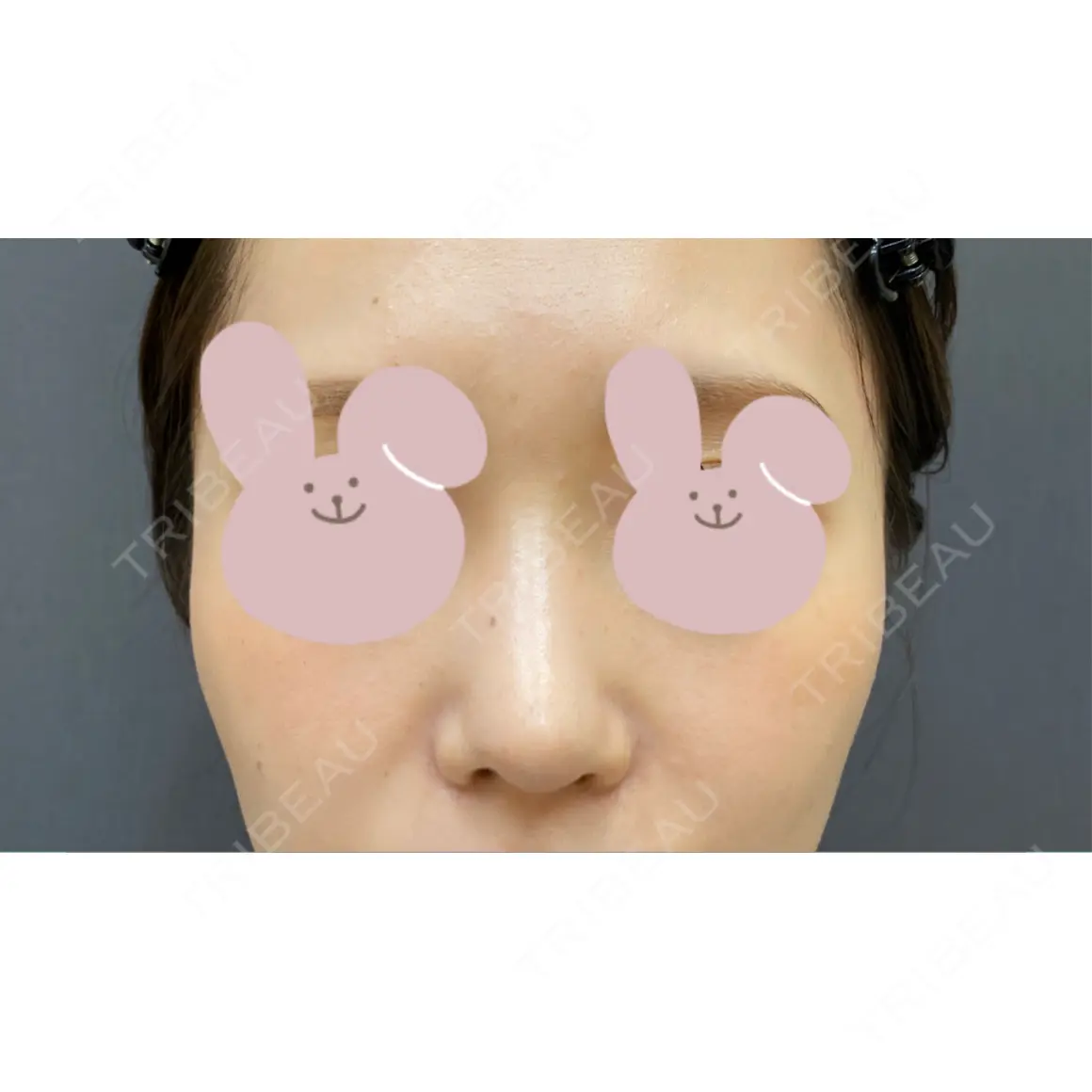 鼻中隔延長（切開） / 軟骨移植 / 鼻翼基部形成（貴族手術） / 鼻柱下降・鼻唇角形成（猫手術） La Clinique Shinjuku 【ラクリニック 新宿】 AFTER