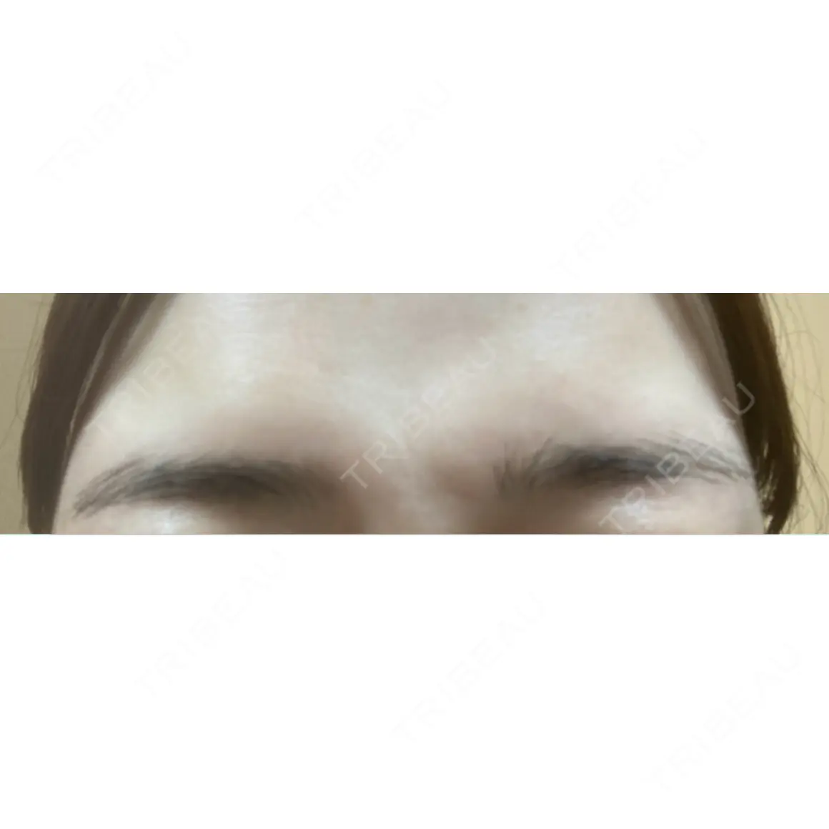 ボトックス（あご） / ボトックス（肩） / ワキ汗治療（ボトックス） / ボトックス（眉間） 共立美容外科 名古屋院 AFTER