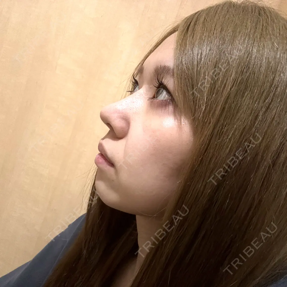 隆鼻術 / 鼻尖形成（切開） / 鼻中隔延長（切開） / 軟骨移植 WOM CLINIC GINZA （ワム クリニック ギンザ） AFTER