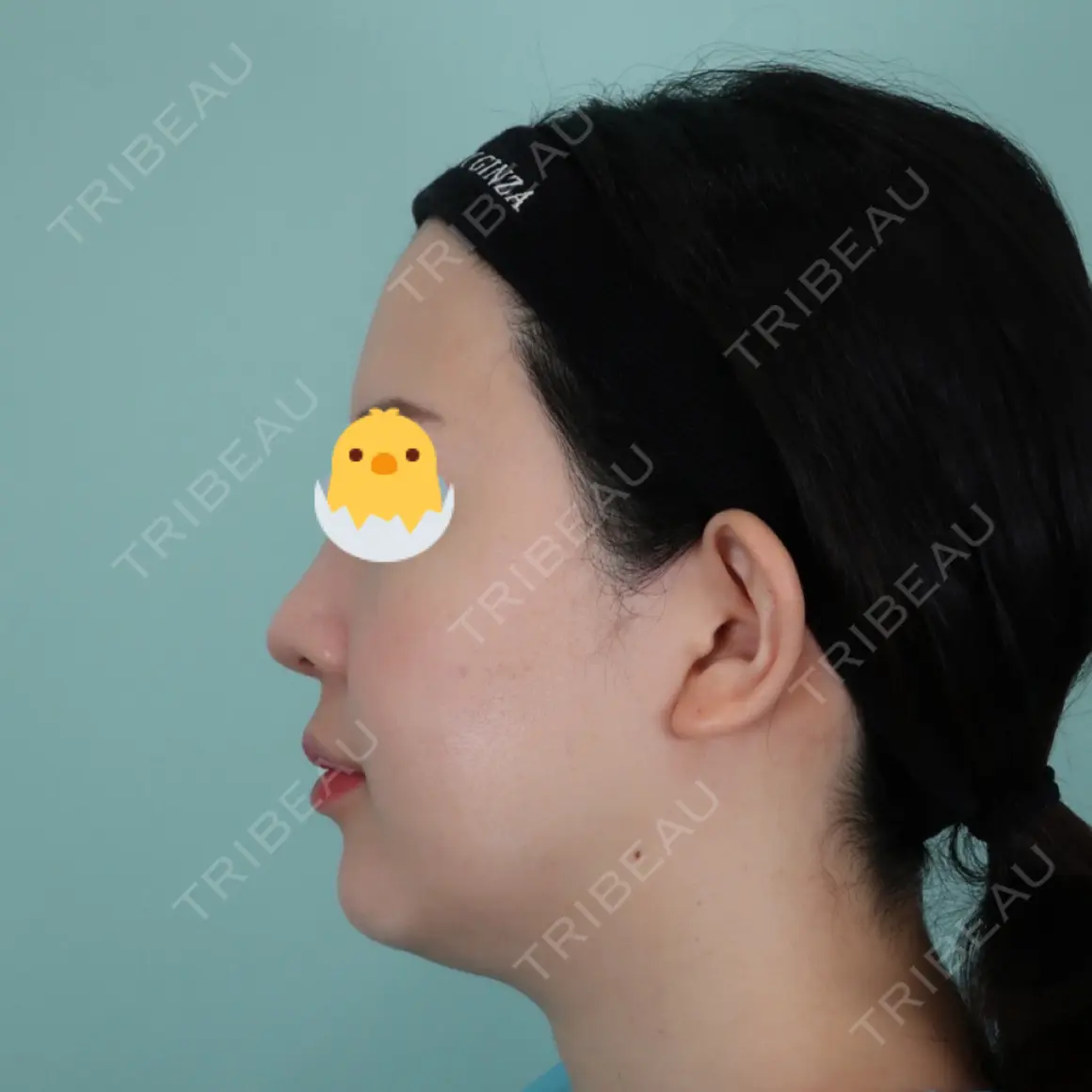 隆鼻術 / 鼻尖形成（切開） / 鼻中隔延長（切開） / 鼻翼基部形成（貴族手術） / 鼻柱下降・鼻唇角形成（猫手術） WOM CLINIC GINZA （ワム クリニック ギンザ） AFTER