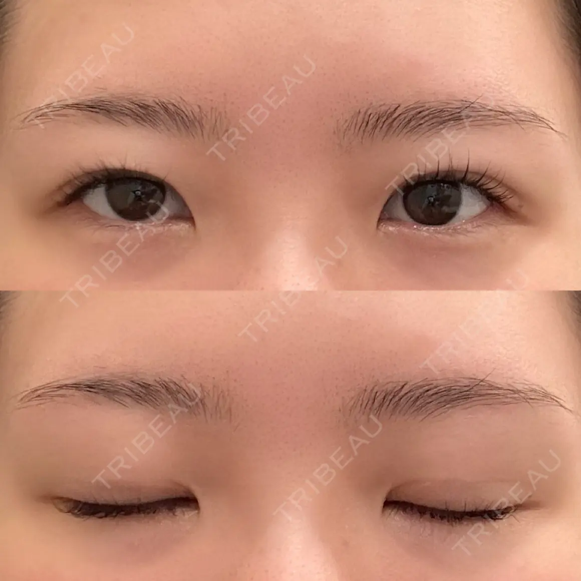 二重切開 オアシス美容外科 AFTER