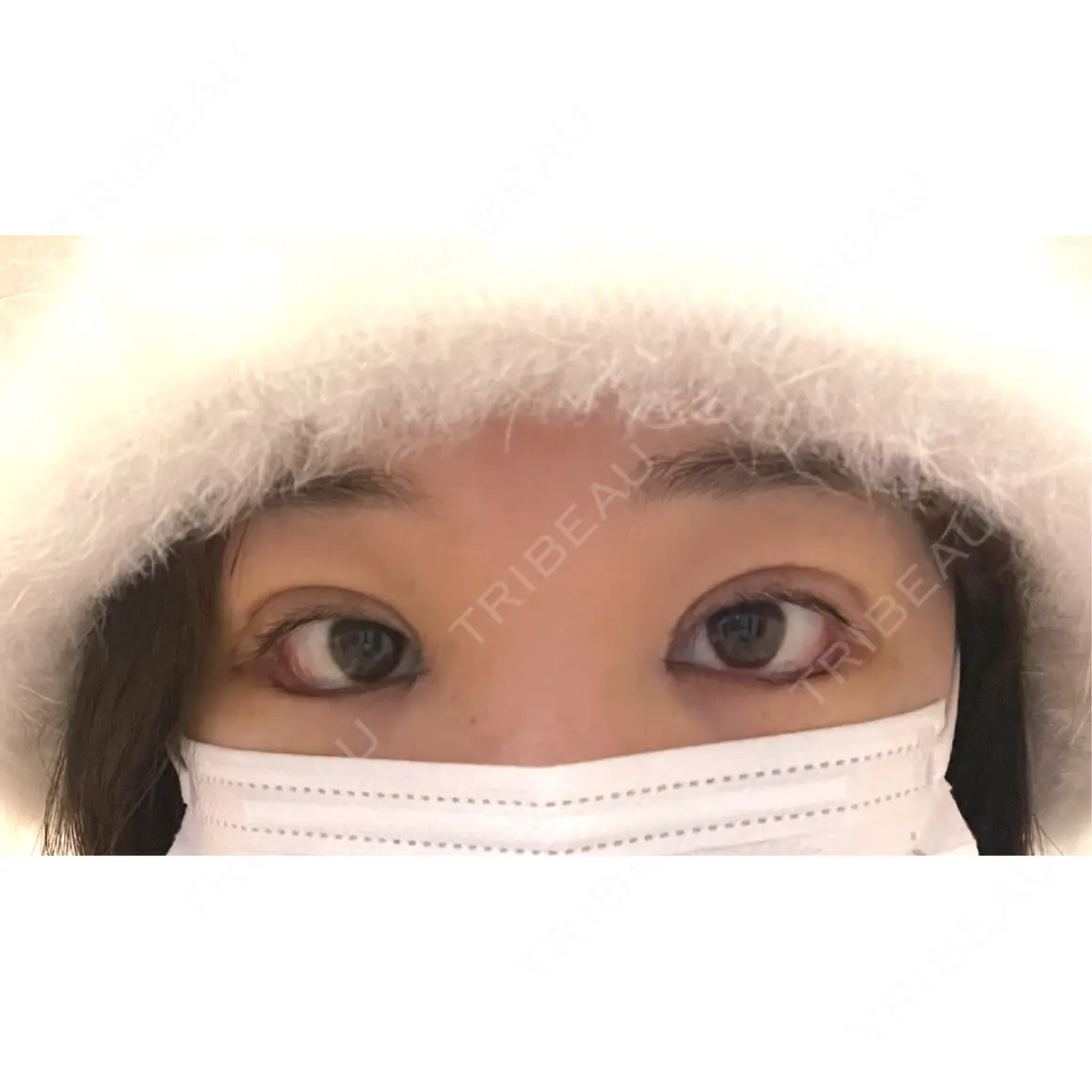 目頭切開 / 目尻切開 / タレ目形成・グラマラスライン（切開） / 自然癒着法 プロミス整形外科 DAY 6
