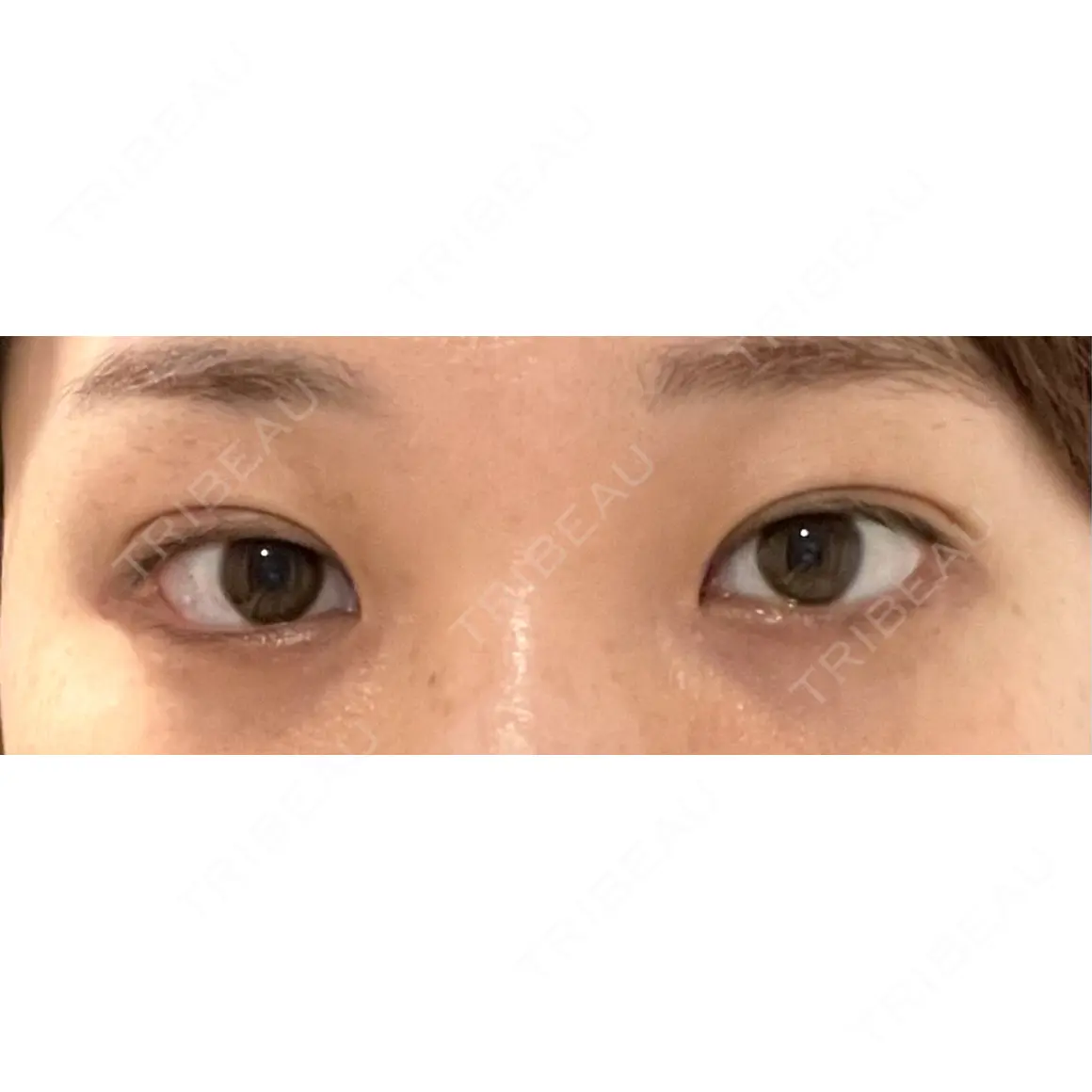 目頭切開 / 目尻切開 / タレ目形成・グラマラスライン（切開） / 自然癒着法 プロミス整形外科 AFTER