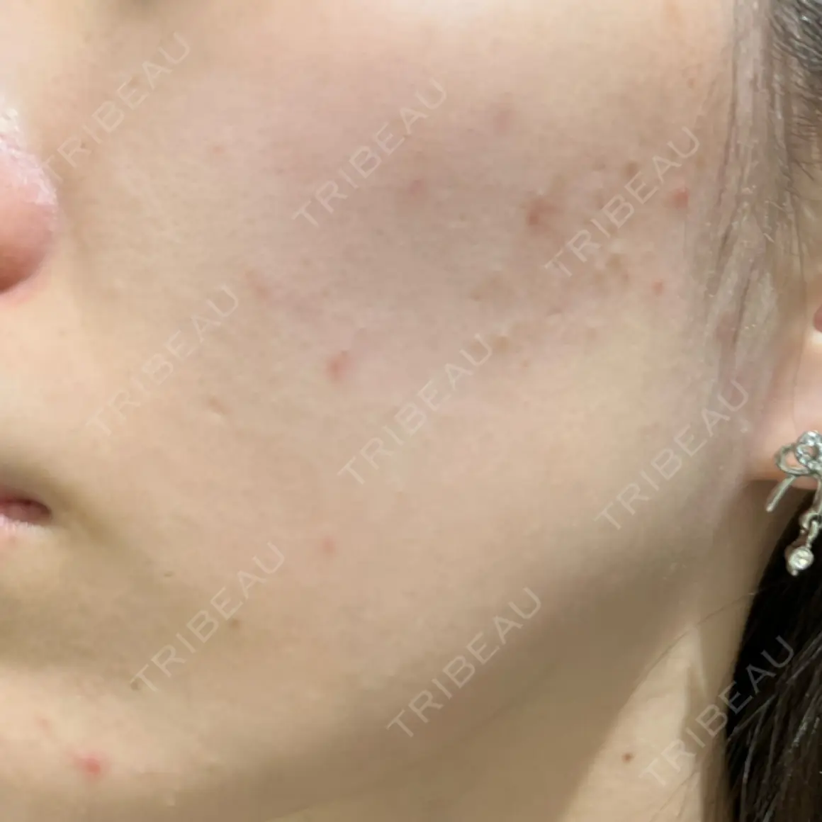ポテンツァ 9BeautyClinic DAY 41