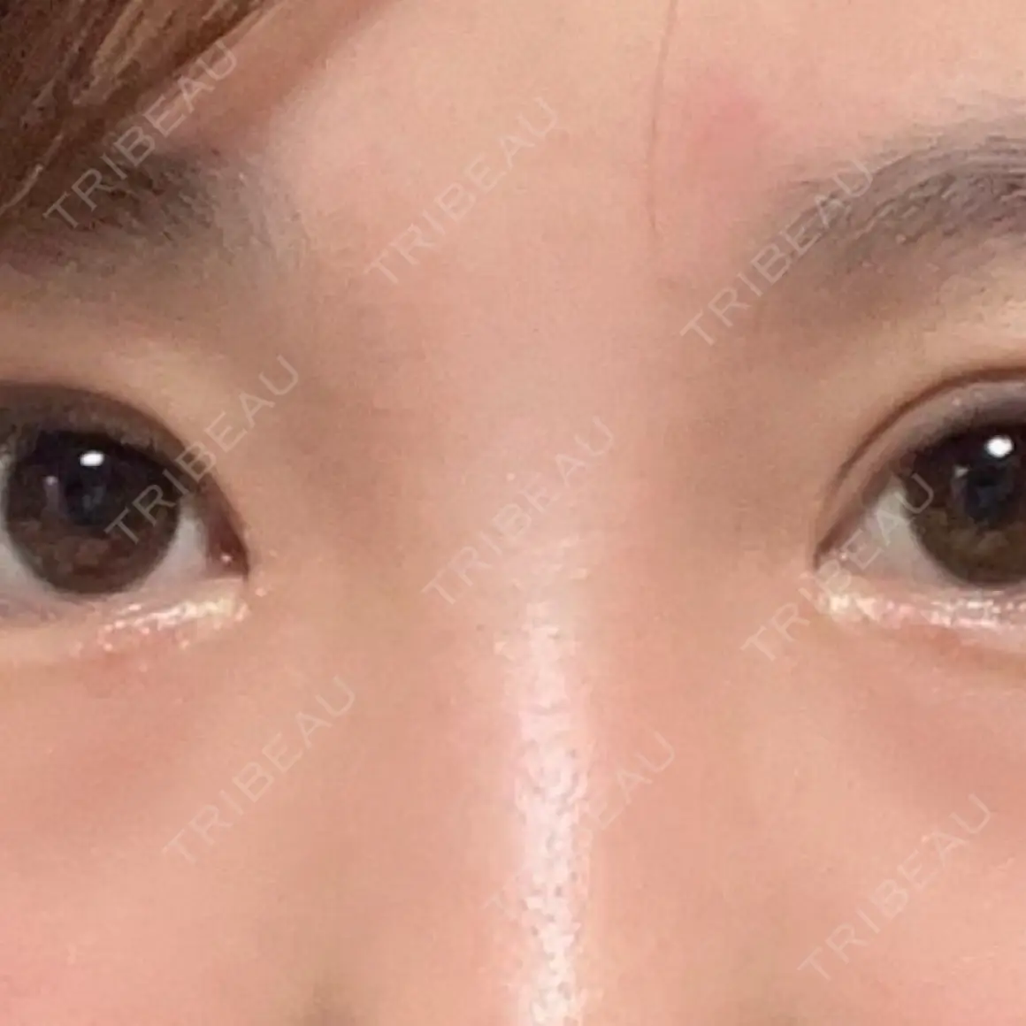 二重切開 / 目頭切開 / 眼瞼下垂（切開） プロミス整形外科 AFTER