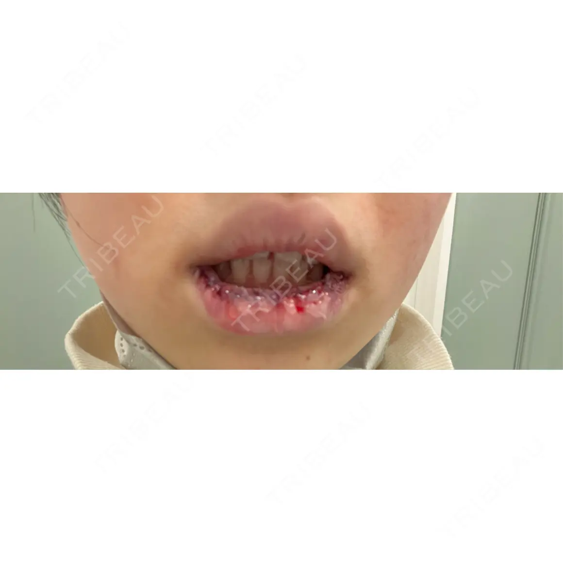 口唇縮小術 くさのたろうクリニック DAY 0