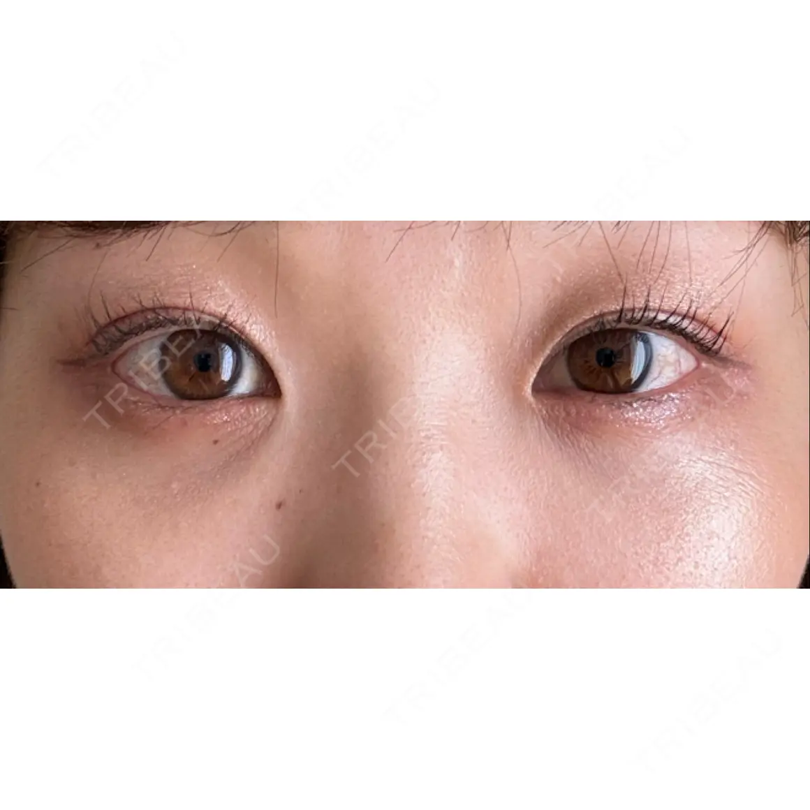 二重埋没 / クマ治療 / 上まぶたの脂肪取り 9BeautyClinic AFTER