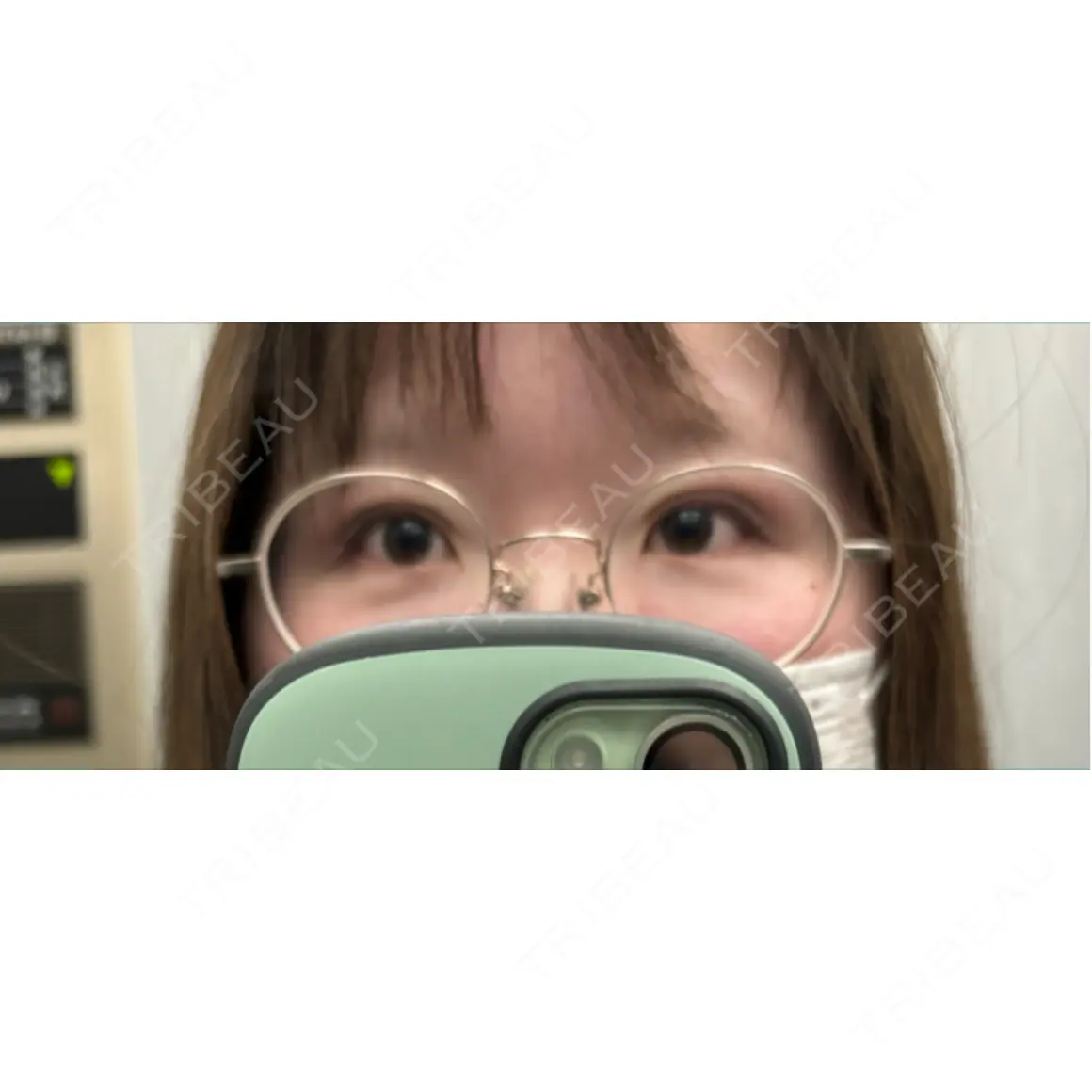 二重埋没 ルラ美容クリニック 神戸院 DAY 0