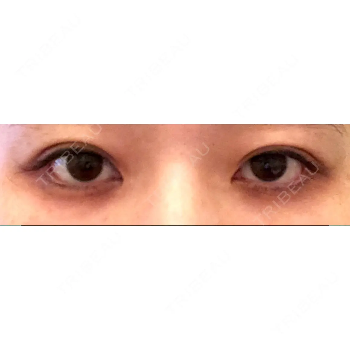 目尻切開 / 下まぶたたるみ取り / 下まぶたの脂肪取り / タレ目形成・グラマラスライン（切開） 湘南美容クリニック 表参道院 AFTER