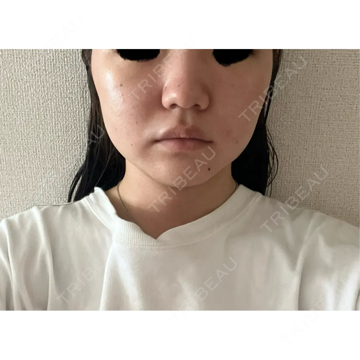 ヴェルヴェットスキン アリエル美容クリニック 郡山院 DAY 7
