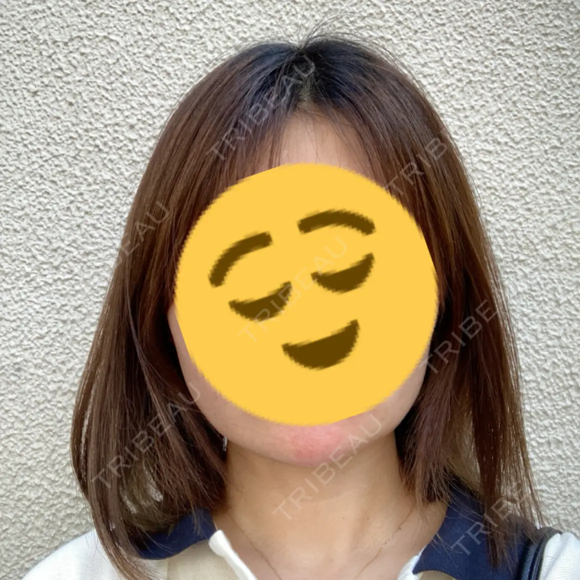 ヒアルロン酸注入（あご） / ボトックス（エラ・小顔） / 白玉点滴・注射 TCB東京中央美容外科 福岡博多院 AFTER