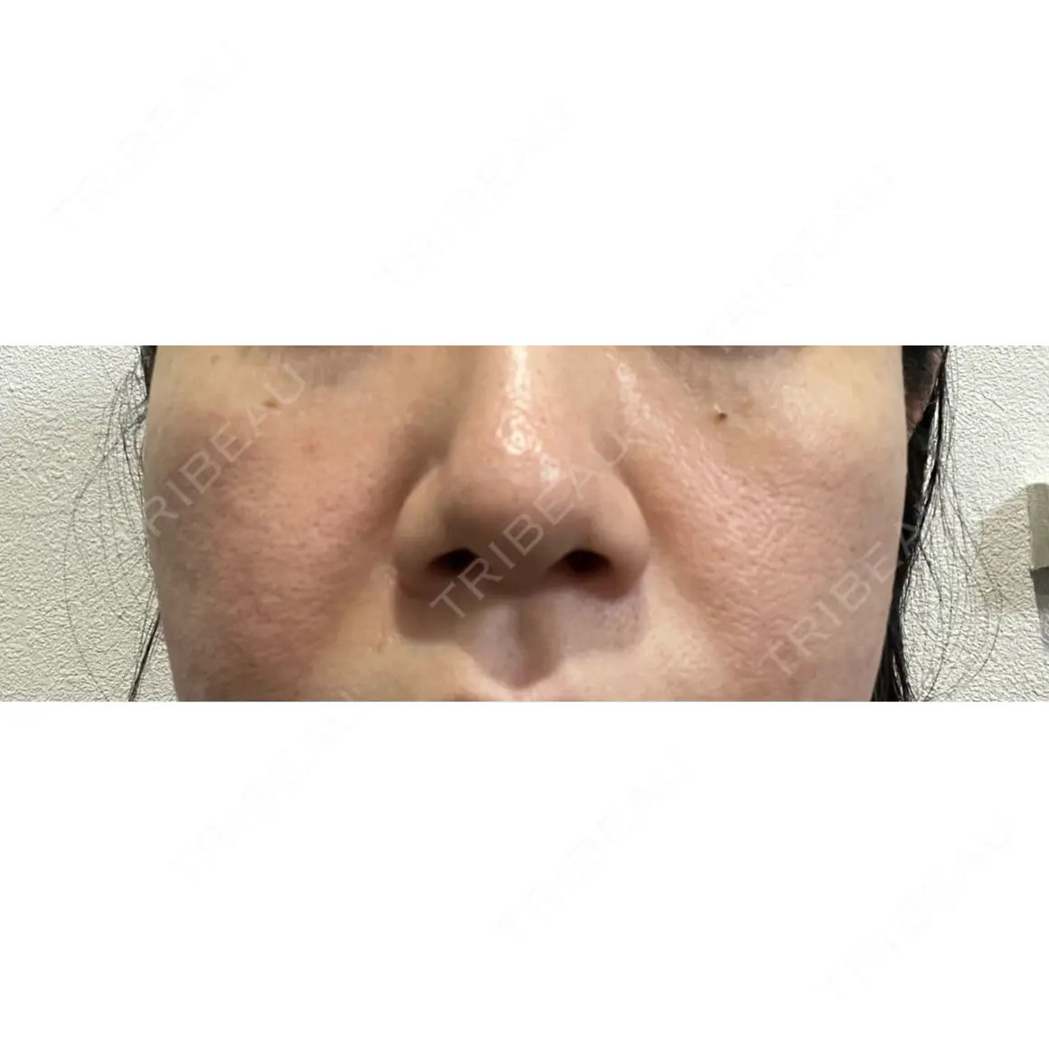 ボトックス（眉間） / 医療脱毛（顔） 共立美容外科 新宿本院 DAY 0