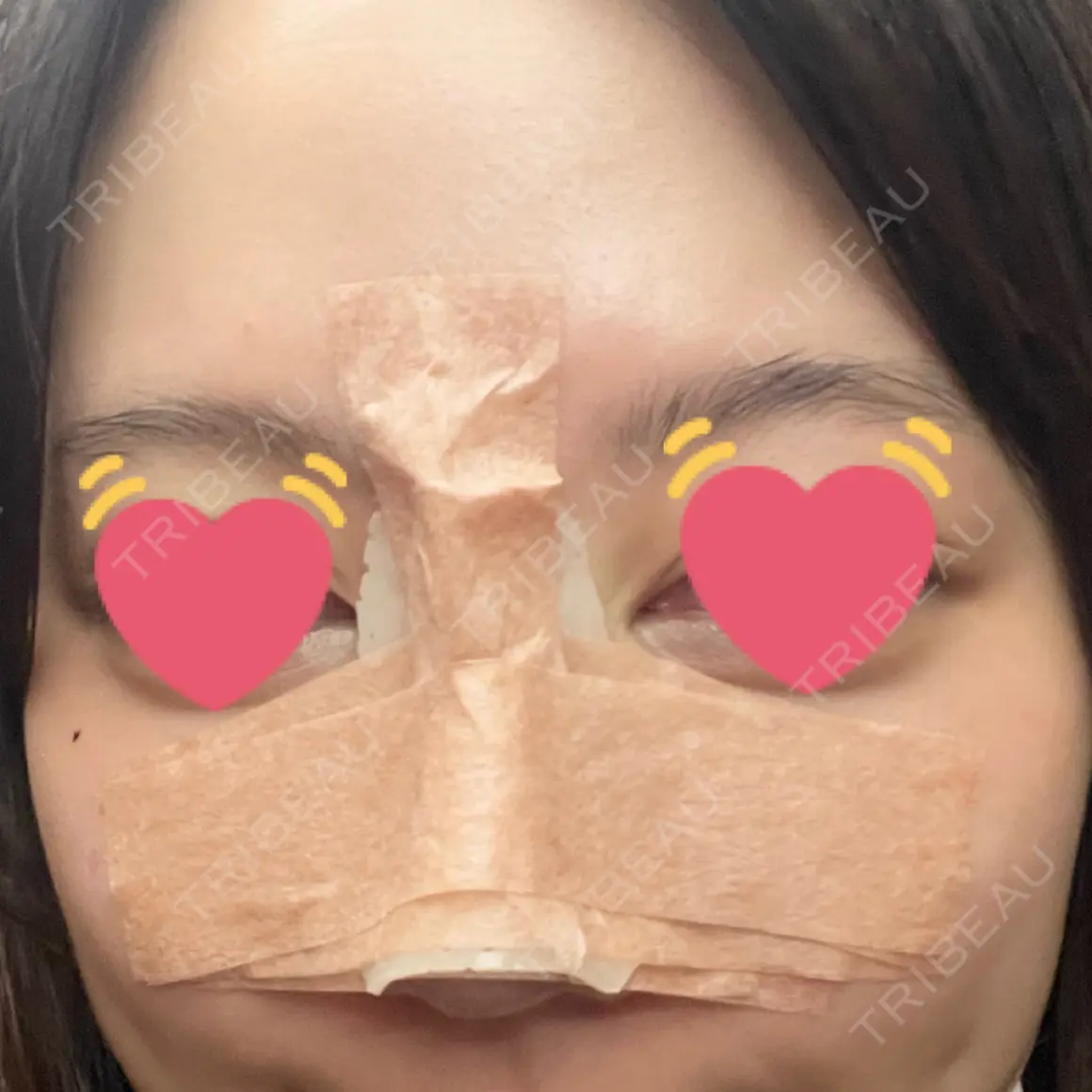 骨切幅寄せ 9BeautyClinic DAY 0