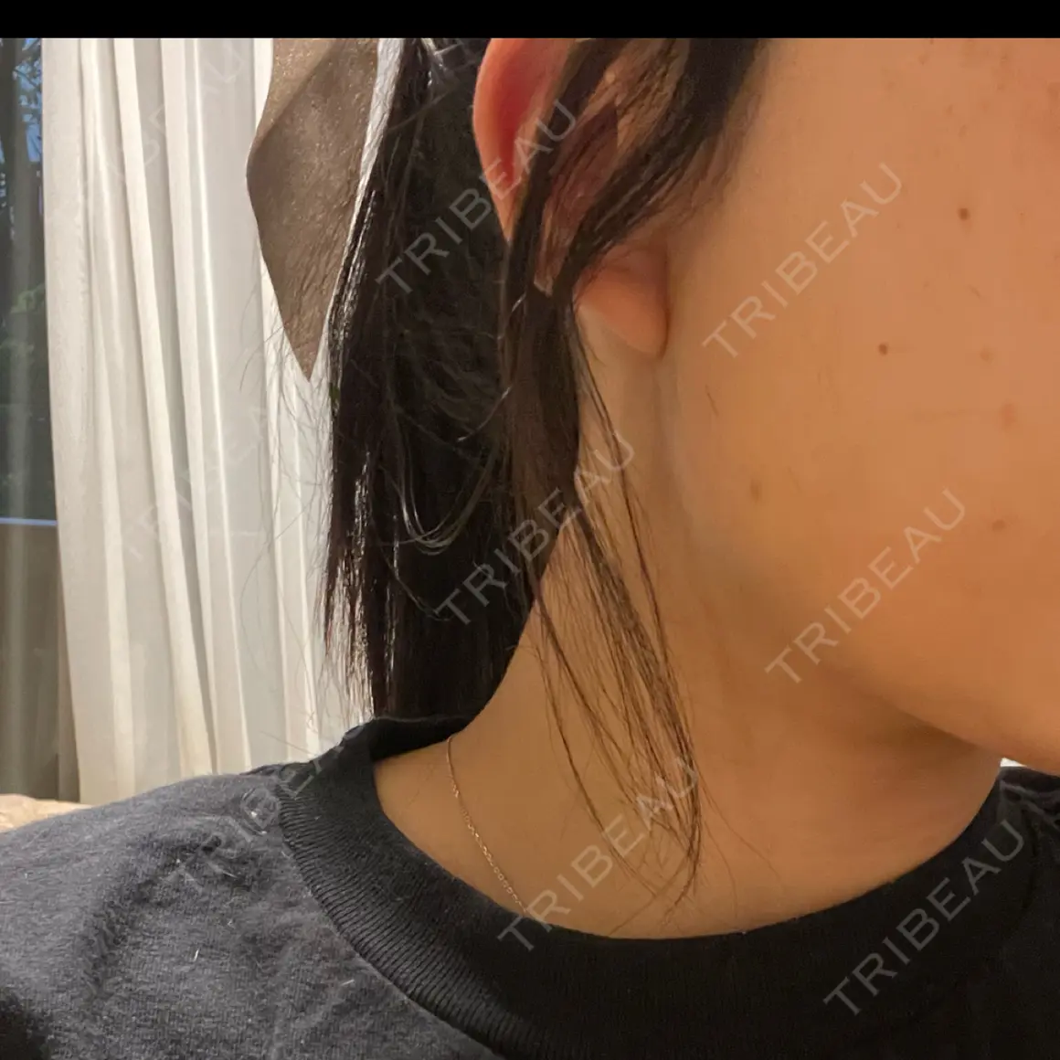 ボトックス（エラ・小顔） TCB東京中央美容外科 高田馬場院 AFTER