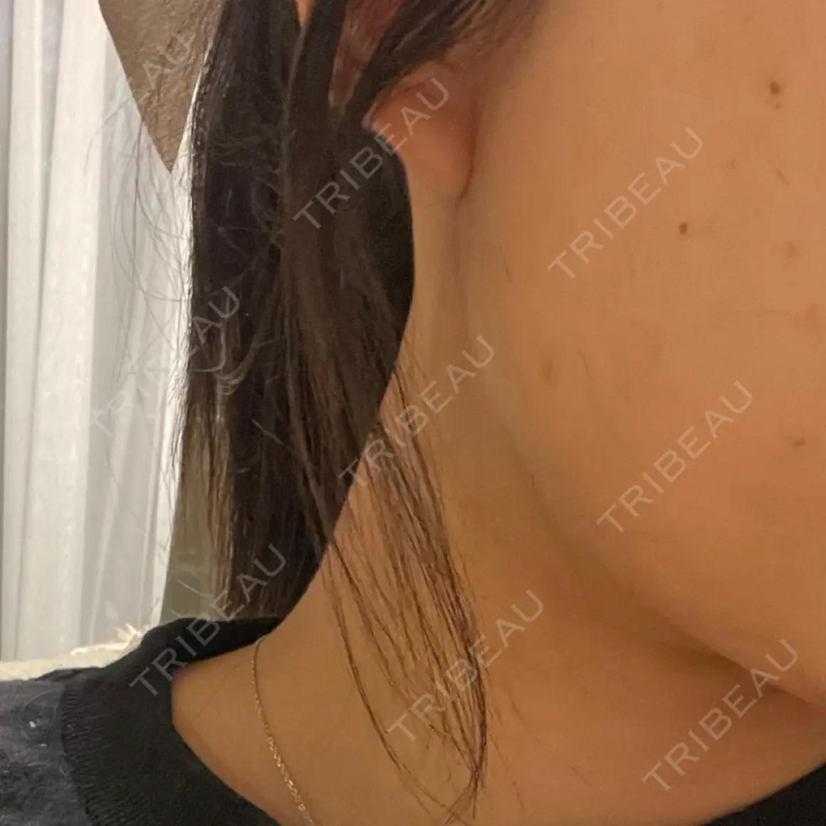 ボトックス（エラ・小顔） TCB東京中央美容外科 高田馬場院 AFTER