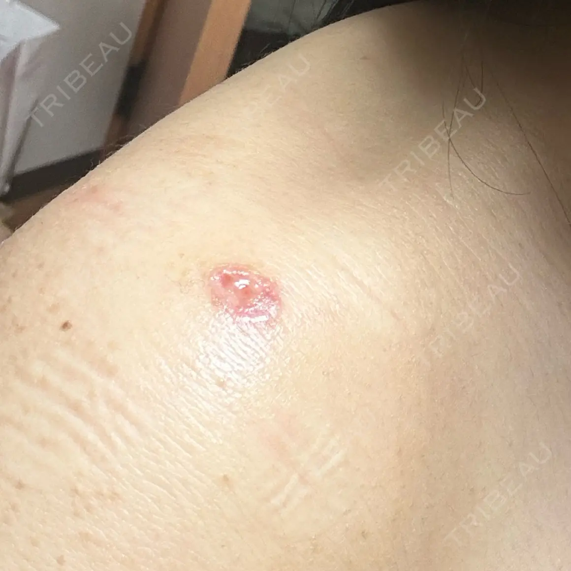 ほくろ・いぼ切除（肌） KARIS beauty clinic AFTER