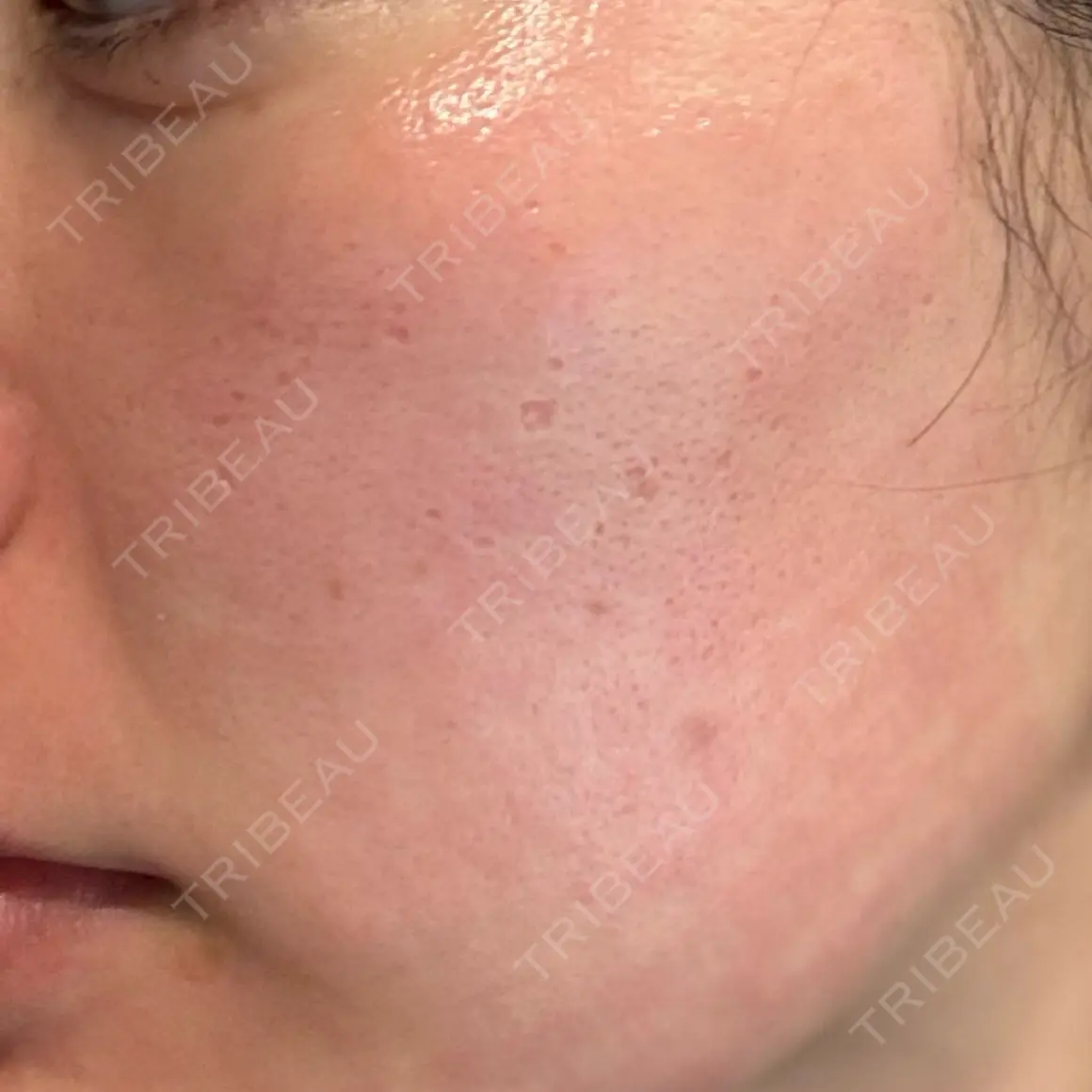 ポテンツァ 9BeautyClinic DAY 0