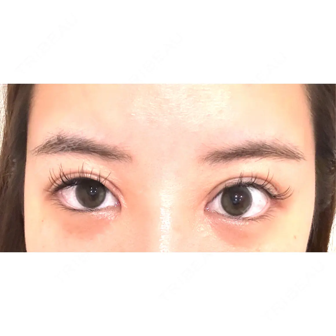 目頭切開 / 眼瞼下垂（切開） Otus Clinic 【オータスクリニック】 AFTER