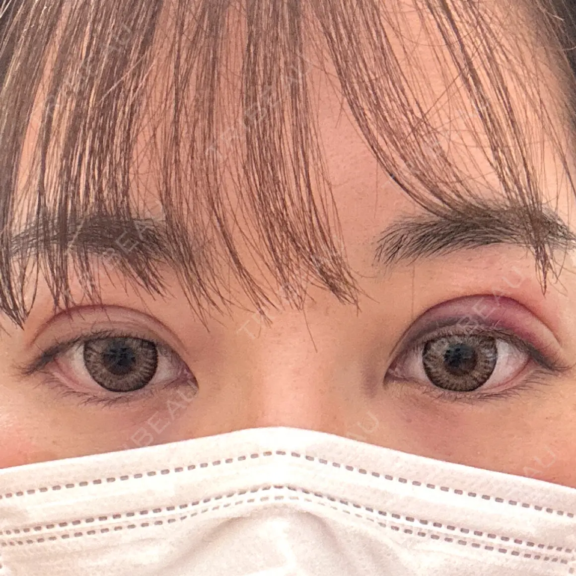 二重埋没 / 上まぶたの脂肪取り ルラ美容クリニック 横浜院 DAY 1