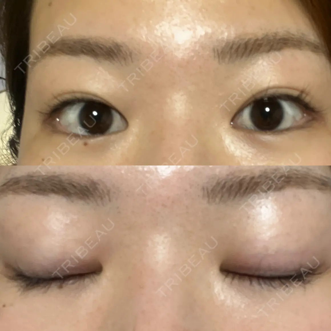 上まぶたの脂肪取り 9BeautyClinic AFTER