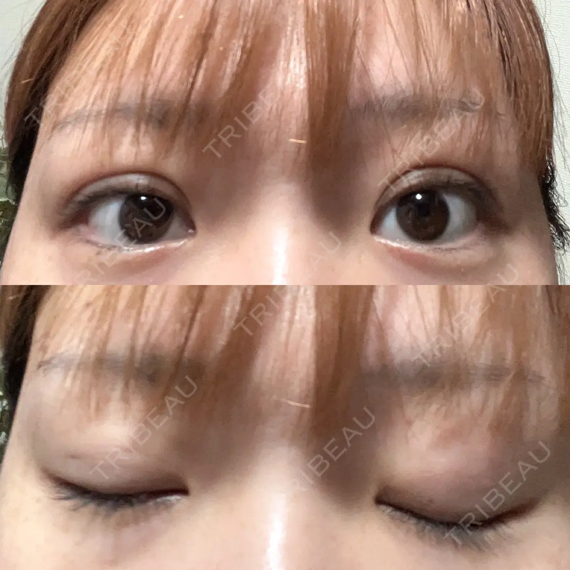 二重埋没 ROOTS Clinic AFTER