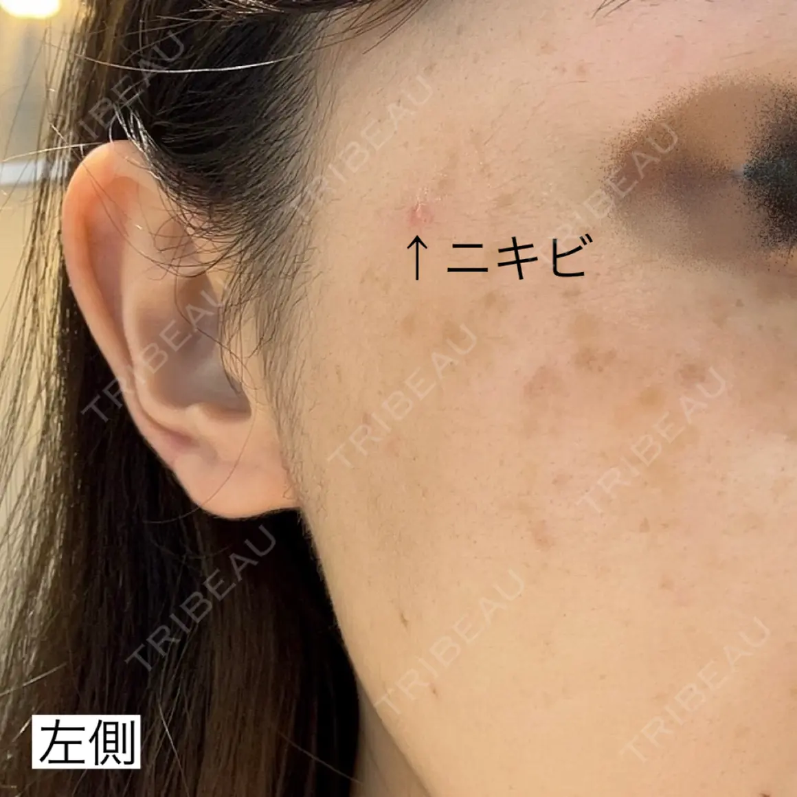 光治療（フォトフェイシャルなど） 湘南美容クリニック 銀座院 AFTER