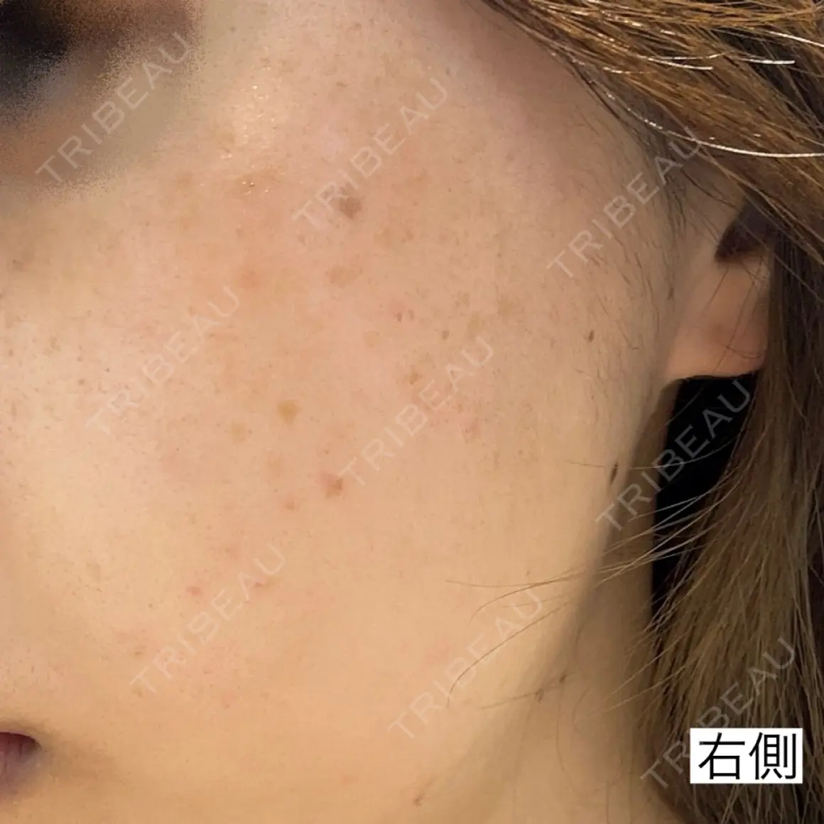 光治療（フォトフェイシャルなど） 湘南美容クリニック 銀座院 AFTER
