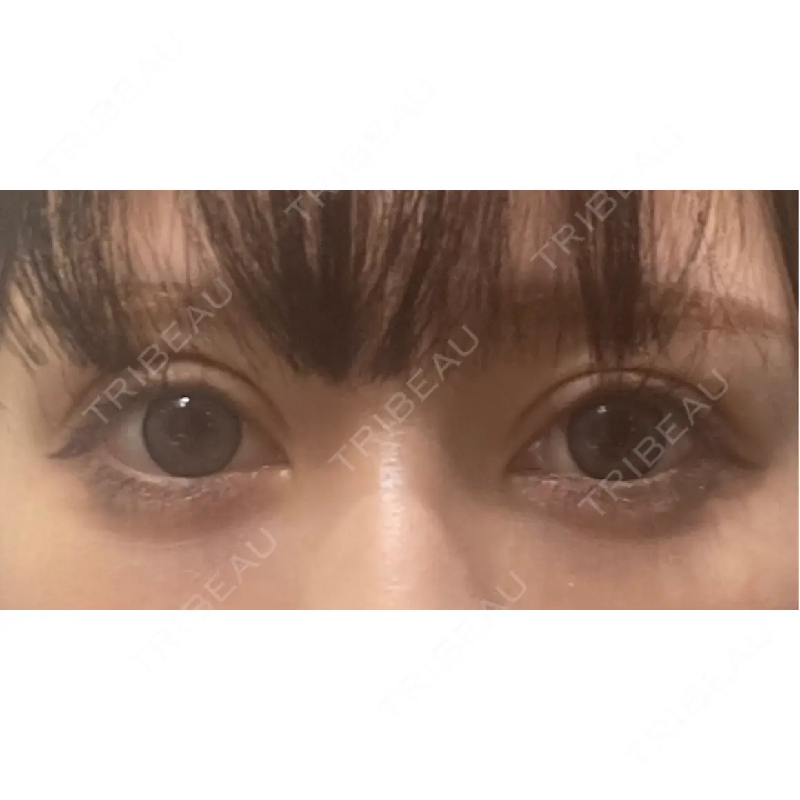 二重切開 / 眼瞼下垂（切開） / 上まぶたたるみ取り / 上まぶたの脂肪取り eクリニック 東京院 AFTER