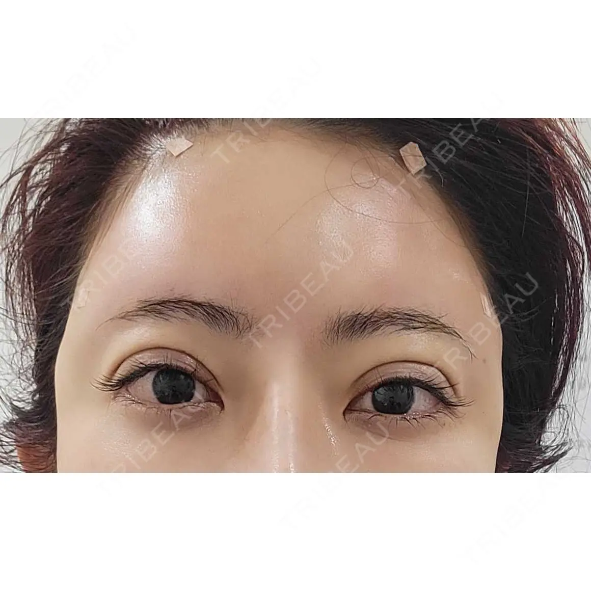 二重埋没 / クマ治療 / 上まぶたの脂肪取り / 脂肪注入（額） / 脂肪注入（目の下） / ボトックス（エラ・小顔） / 脂肪溶解注射（顔） / 脂肪注入（輪郭） / ヒアルロン酸注入（鼻翼基部） HAAB×DREAM BEAUTY CLINIC 東京本院 DAY 0