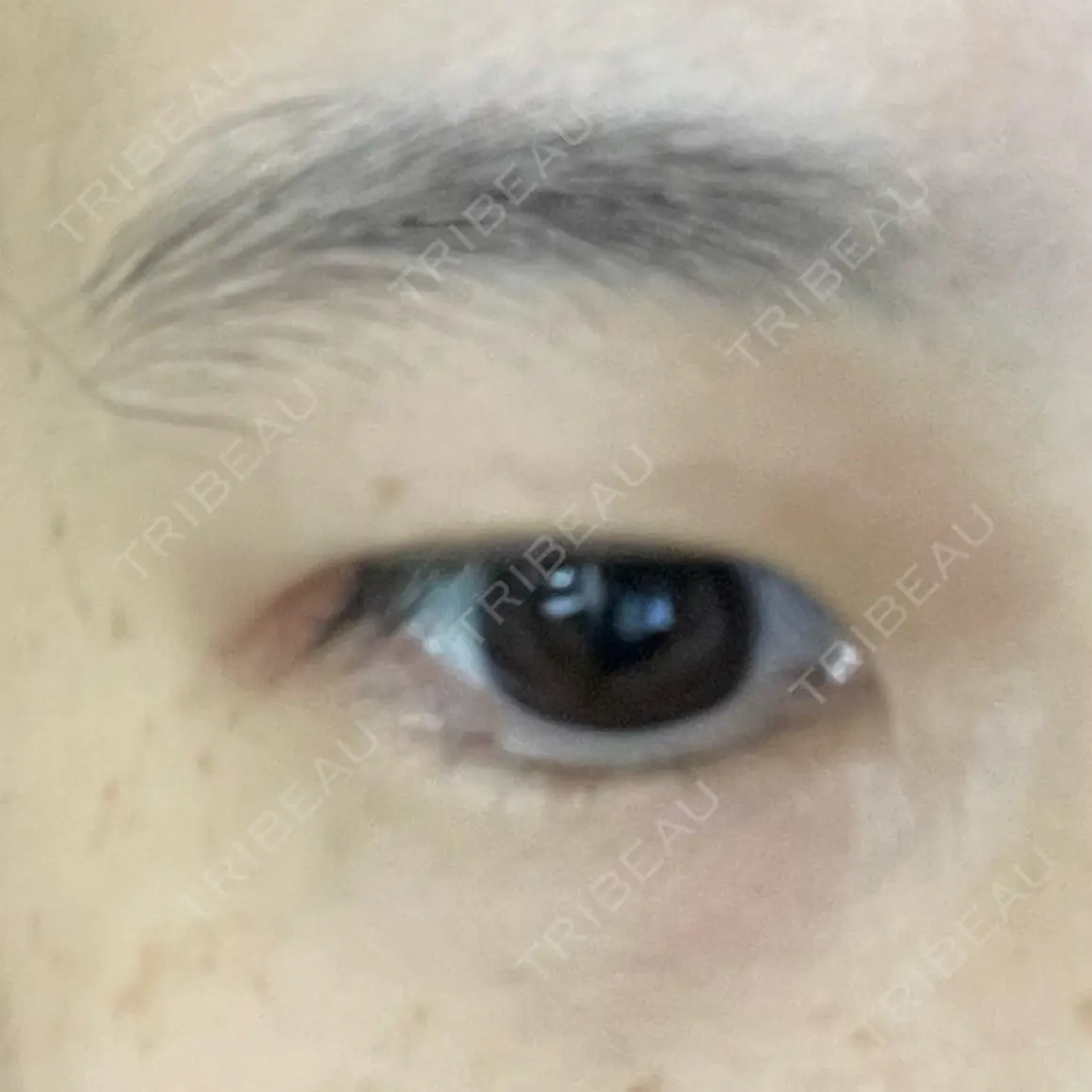 二重埋没 銀座高須クリニック AFTER