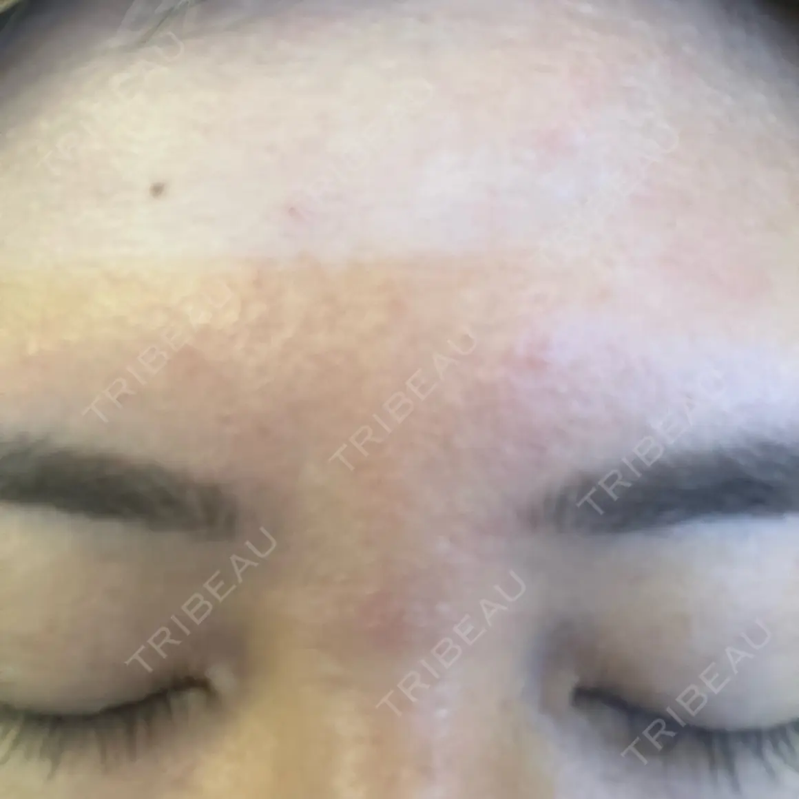 ボトックス（あご） / ボトックス（口角） / ボトックス（眉間） WellnessPlus Clinic 【ウェルネスプラスクリニック】 AFTER