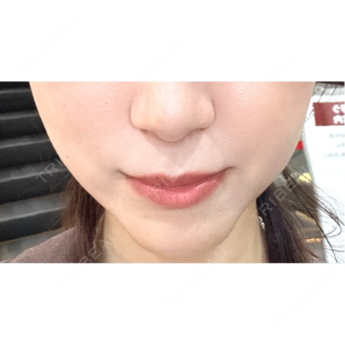ヒアルロン酸注入（あご） ルラ美容クリニック 町田院 AFTER
