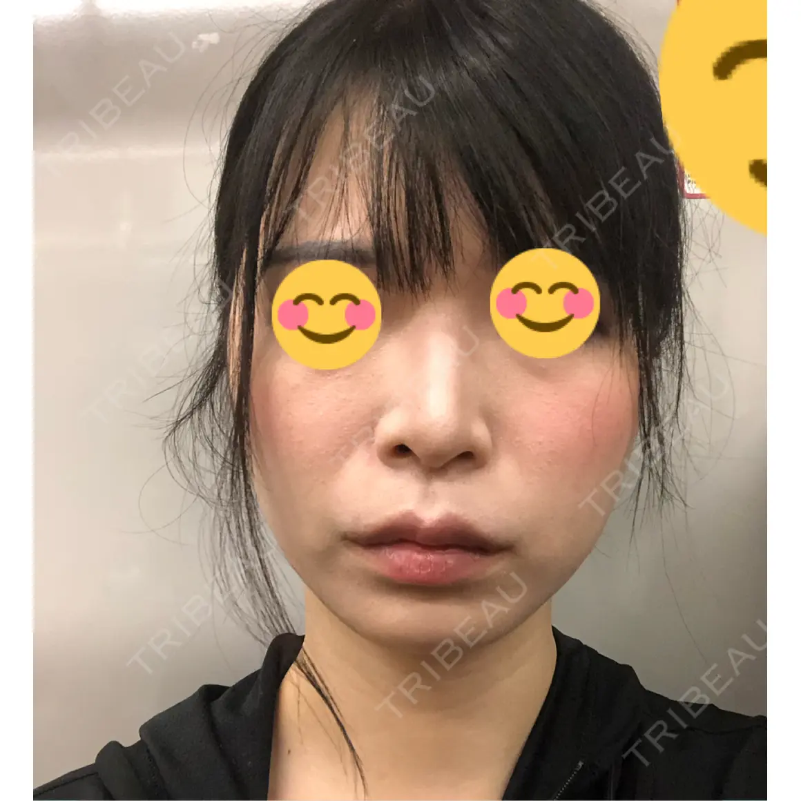 脂肪注入（肌） EMMO FACE CLINIC 大宮院 AFTER