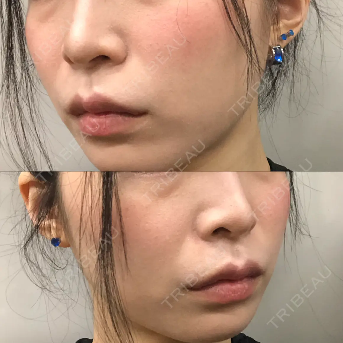 脂肪注入（肌） EMMO FACE CLINIC 大宮院 AFTER