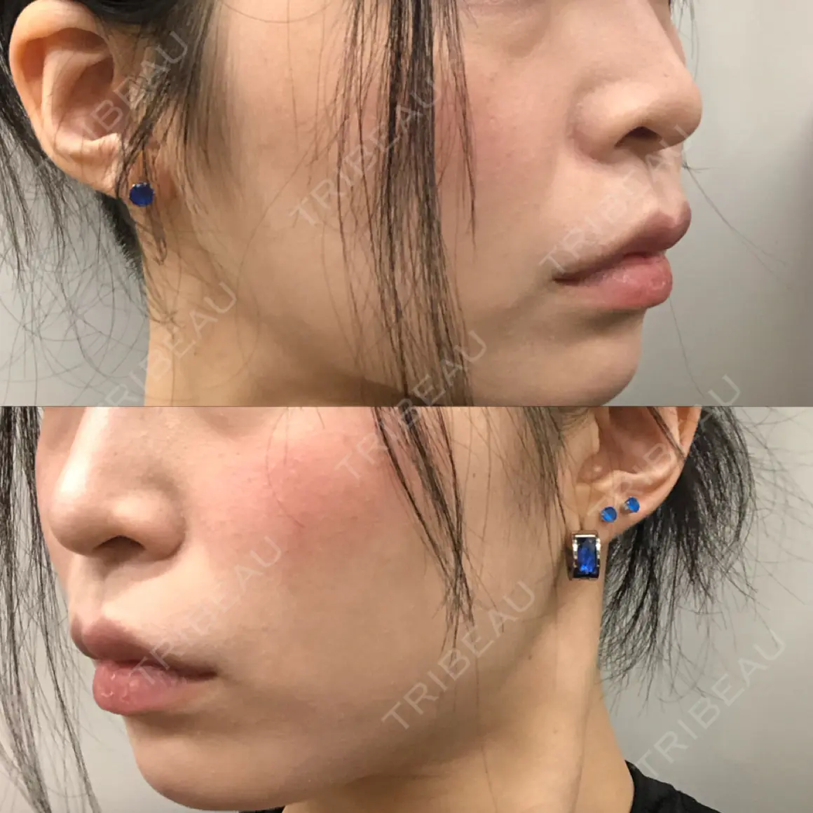 脂肪注入（肌） EMMO FACE CLINIC 大宮院 AFTER