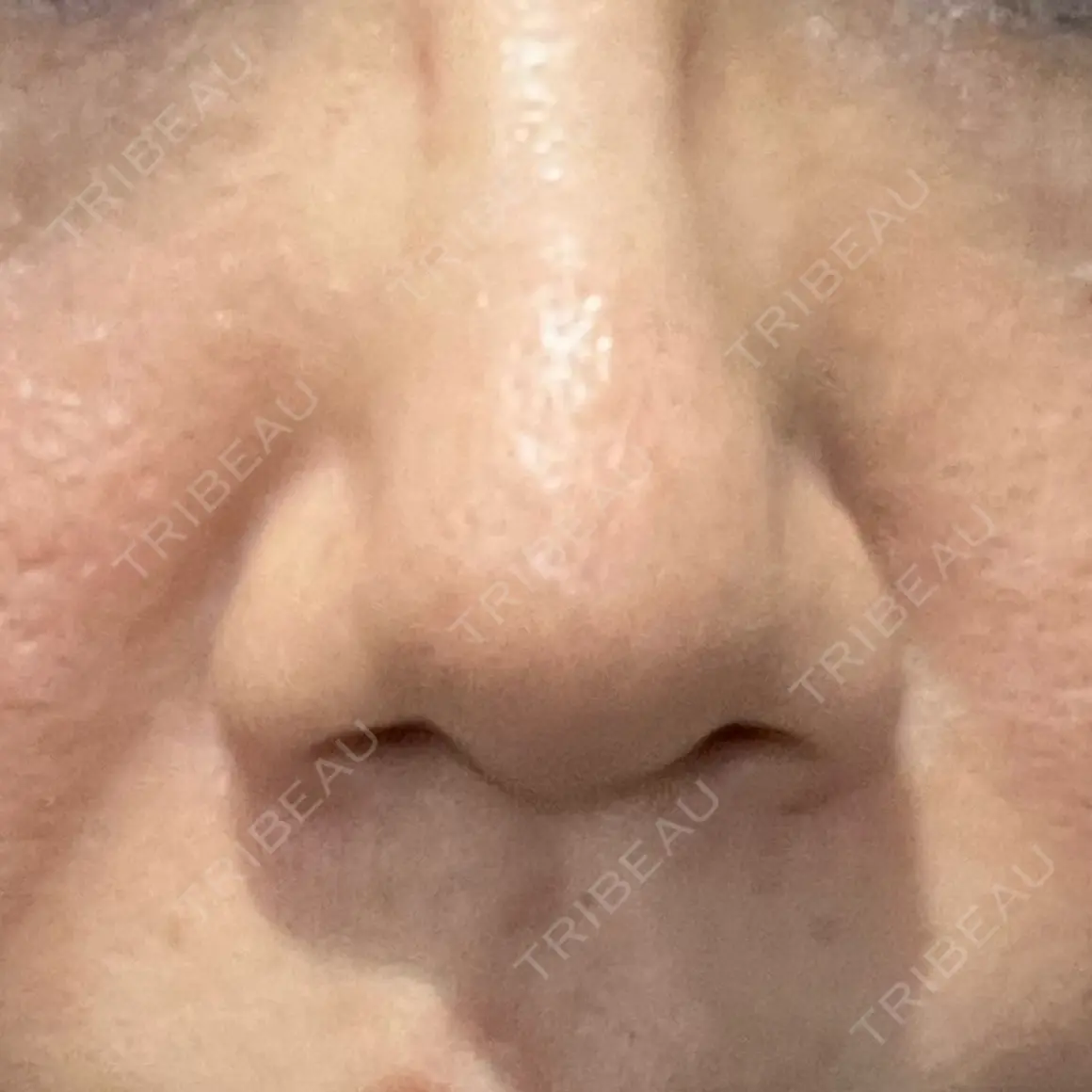 ボトックス（眉間） / 医療脱毛（顔） 共立美容外科 新宿本院 AFTER