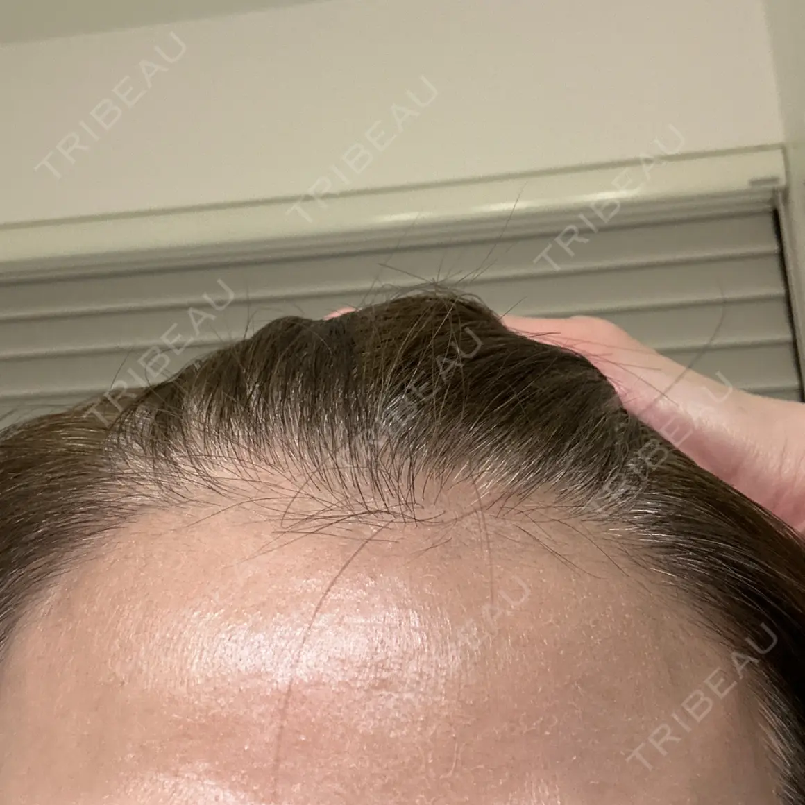 ボトックス（眉間） / ボトックス（額） WellnessPlus Clinic 【ウェルネスプラスクリニック】 AFTER