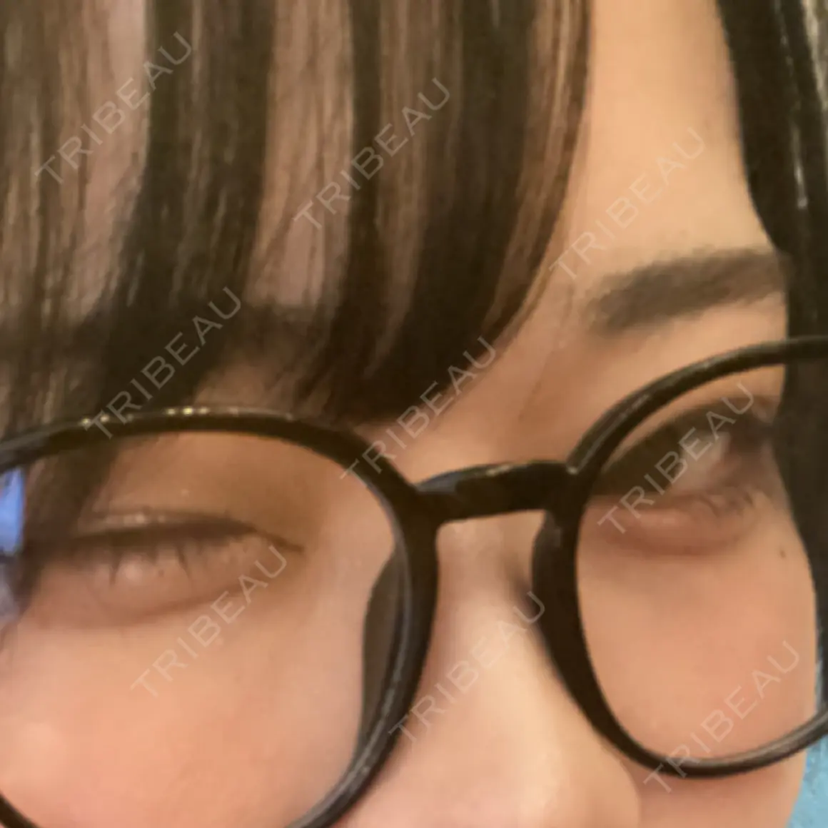 ヒアルロン酸注入（涙袋） Code Beauty Clinic 名古屋院 DAY 1